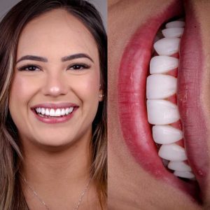 dra-nil-markene-lentes-de-resina-porcelana-botox-goiania-02